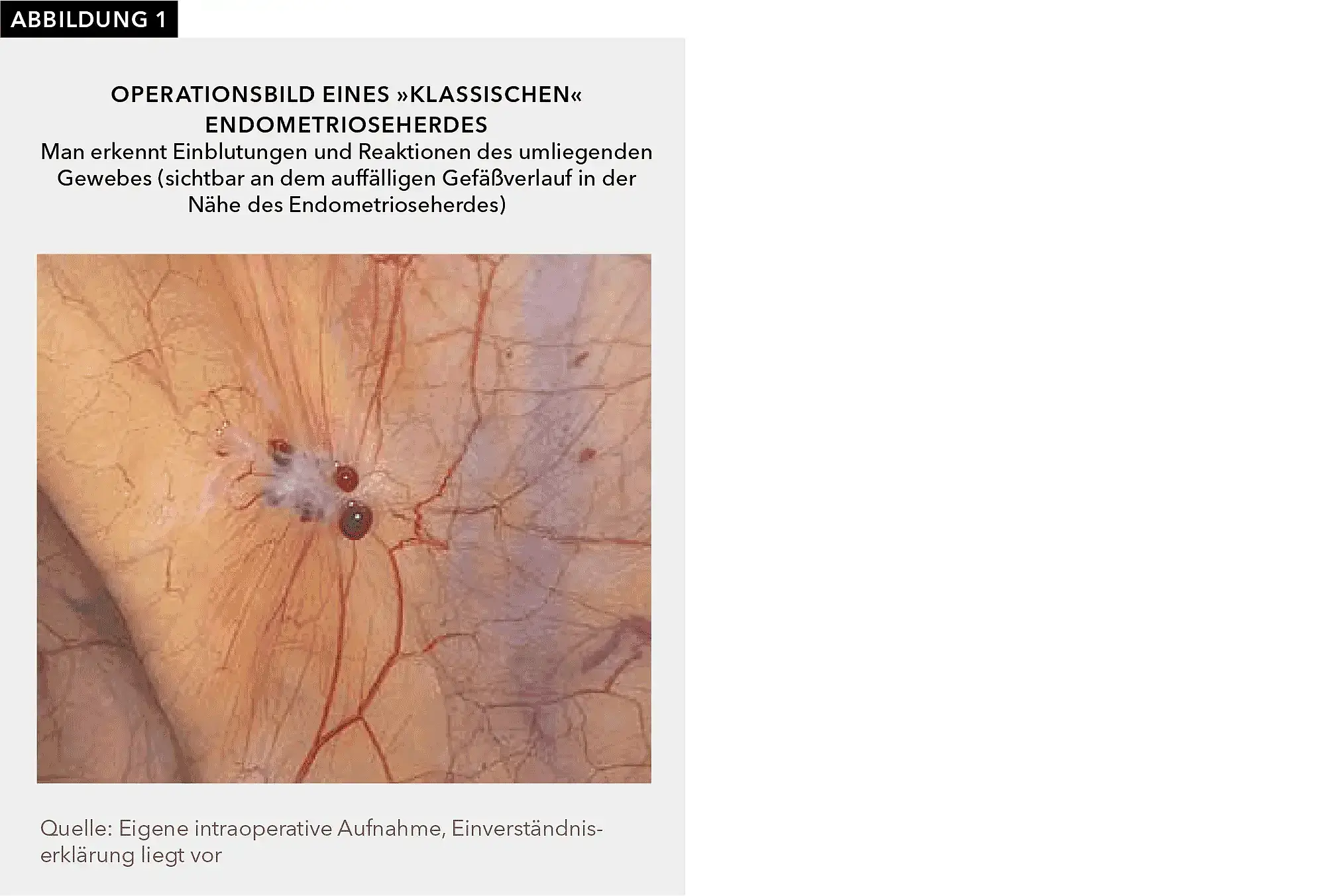 Abbildung 1 ist ein Foto, das Gewebeveränderungen durch eine Endometriose am Bauchfell zeigt.